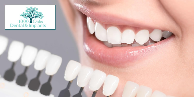 5 Surprising Ways Dental Veneers Can Enhance Your Smile! - 1000oaks ...